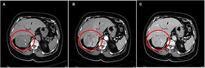 Frontiers | Case Report: A Virilizing Adrenal Oncocytoma