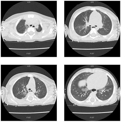 Frontiers | Long-Term Pulmonary Damage From SARS-CoV-2 in an Infant ...