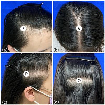Ludwig Scale  Female Baldness Pattern  Heva Clinic