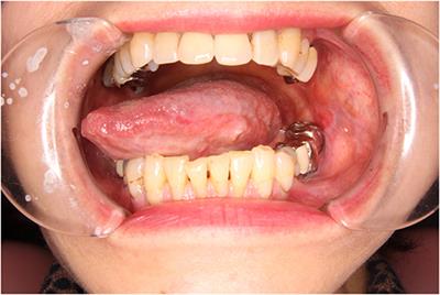 erythroplakia floor of mouth