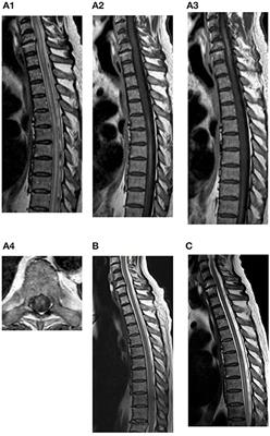 Frontiers | Case Report: Longitudinal Extensive Transverse Myelitis ...