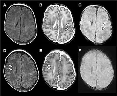 Frontiers | Nosological Differences in the Nature of Punctate White ...