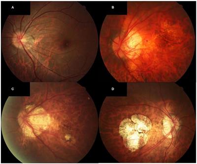 Frontiers | Investigation of Macular Choroidal Thickness and Blood Flow ...