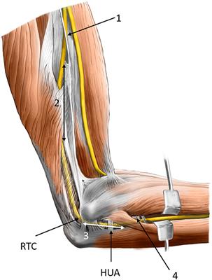 Ulnar Neuropathy at the Elbow (Cubital Tunnel Syndrome