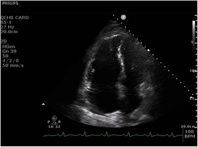 Frontiers | Utility of Non-invasive Cardiac Imaging Assessment in ...