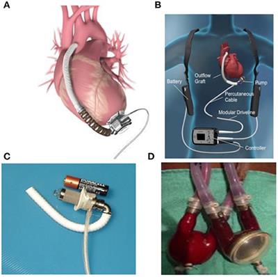 Frontiers | Pediatric Mechanical Circulatory Support: Pathophysiology ...