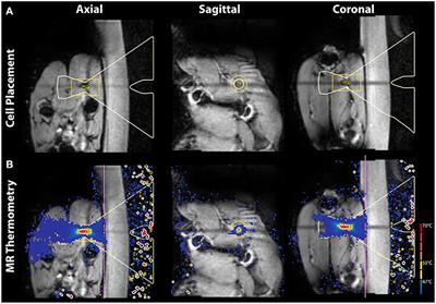 Frontiers  Case report: Use of peripheral nerve stimulation for treatment  of pain from vertebral plana fracture