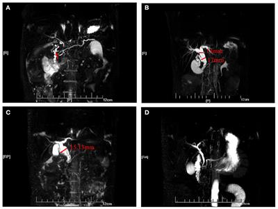 Frontiers | Clinical Characteristics of Paediatric Pancreatitis Caused ...