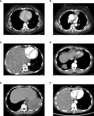 Frontiers | Solitary Fibrous Tumors of the Chest: An Analysis of Fifty ...