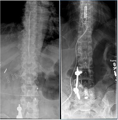 Spinal Cord Stimulation For Failed Back Surgery Patients