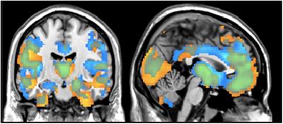 Frontiers | Spatially Covarying Patterns of Gray Matter Volume and ...