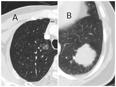 Frontiers | Clinical Features and Survival Outcome of Early-Stage ...