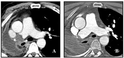 Frontiers | Pulmonary Artery Stump Thrombosis: To Treat or Not to Treat ...