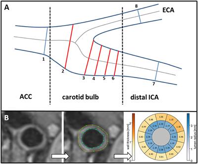 frontiers carotid geometry and wall shear stress independently predict increased wall thickness a longitudinal 3d mri study in high risk patients cardiovascular medicine