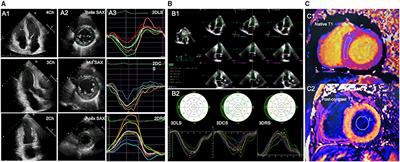 Left ventricular global strains by linear measurements in three
