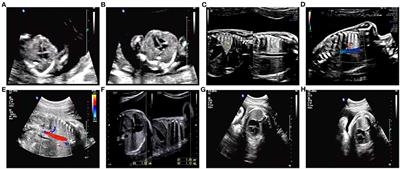 Frontiers | Case Report: Paternal Uniparental Isodisomy and ...