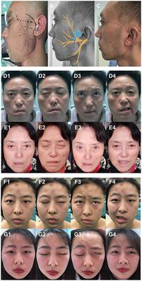 Key Pearls for Managing a Facial Nerve Palsy Patient - American