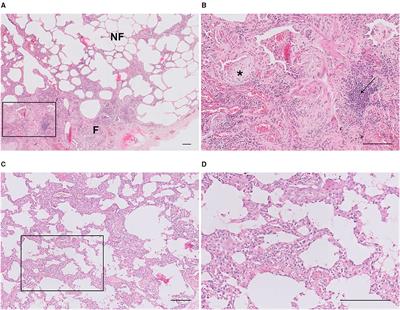 Frontiers | The Extent of Inflammatory Cell Infiltrate and Fibrosis in ...