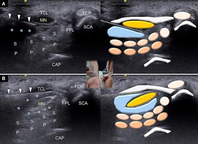 Incisionless, ultrasound-guided approach for carpal tunnel release