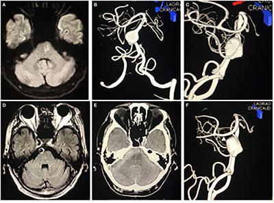 Frontiers | Partial Clipping Occlusion Including Rupture Point Is an ...