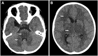 Frontiers | Case Report: Fatal Neurotoxicity Following Resmethrin ...