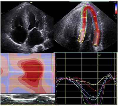 Figure 4 from The Imaging Diagnosis of Less Advanced Cases of Cardiac  Amyloidosis: The Relative Apical Sparing Pattern