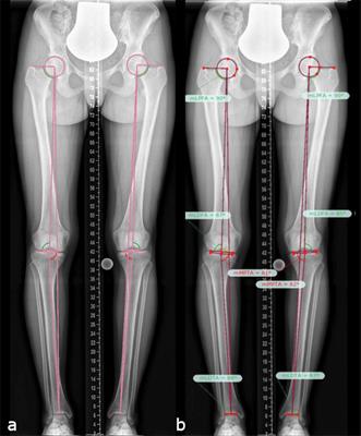 Frontiers | Lower Limb Deformity and Gait Deviations Among Adolescents ...