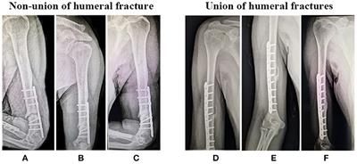 Patient with tibia nonunion. a X-ray from the pre-treatment period