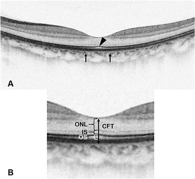 Frontiers | Factors Associated With the Presence of Foveal Bulge in ...