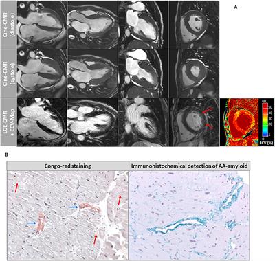 Frontiers  Cardiac Amyloidosis: A Review of Current Imaging Techniques