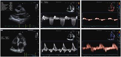 Early Diastolic Longitudinal Strain Rate at MRI and Outcomes in Heart  Failure with Preserved Ejection Fraction