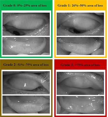 Frontiers | Meibomian Gland Morphology Changes After Cataract Surgery ...