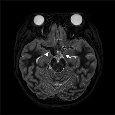 Frontiers | Diffuse Cerebral Vasospasm After Aneurysmal Subarachnoid ...