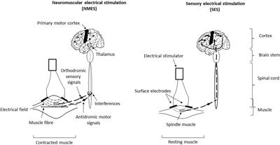 Example of transdermal electric muscle stimulation by means of a