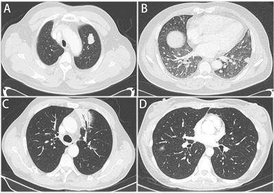 Frontiers | Clinical Features and Surgical Treatment of Primary ...