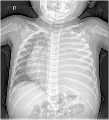 Frontiers | Case Report: Pleuropulmonary Blastoma in a 2.5-Year-Old Boy ...