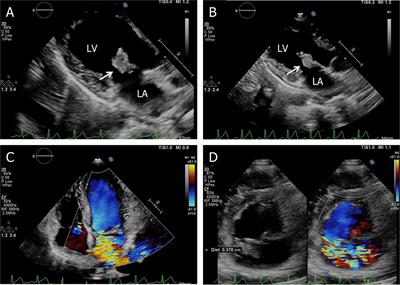 Frontiers | Abiotrophia Defectiva as a Rare Cause of Mitral Valve ...