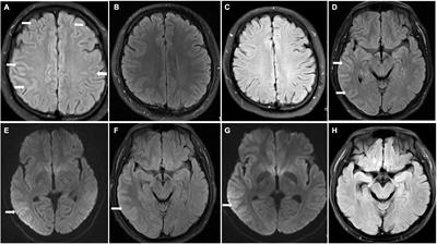 Frontiers | Myelin Oligodendrocyte Glycoprotein Antibody Associated ...