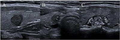 Frontiers | Clinical Study of Ultrasonographic Risk Factors for Central ...