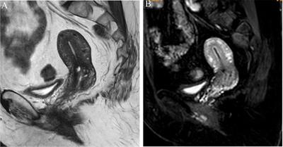 Frontiers | Peritumoral Enhancement for the Evaluation of Myometrial ...