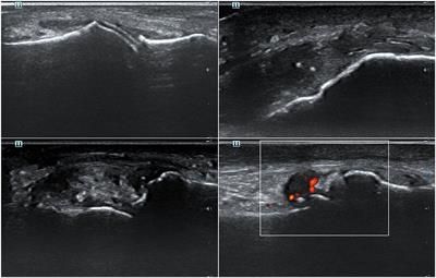 Frontiers | Sonographic Tophi and Inflammation Are Associated With ...