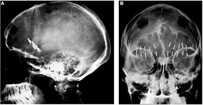 Frontiers  The Evolution of Modern Ablative Surgery for the Treatment of  Obsessive-Compulsive and Major Depression Disorders