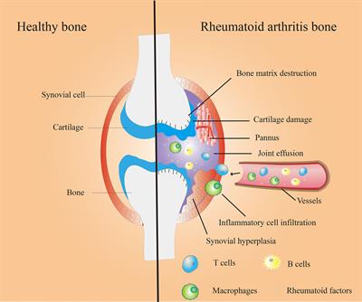 pathophysiology of rheumatoid arthritis diagram