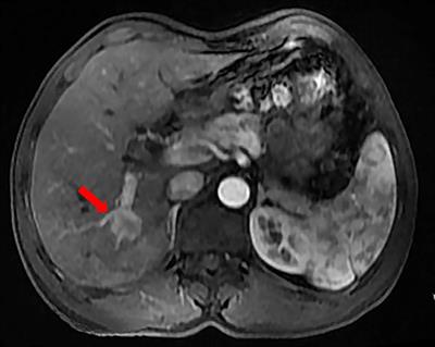 Frontiers | Case Report: Pancreatic Neuroendocrine Tumor With Liver ...