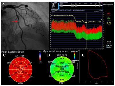 Frontiers  Left Ventricular Strains and Myocardial Work in