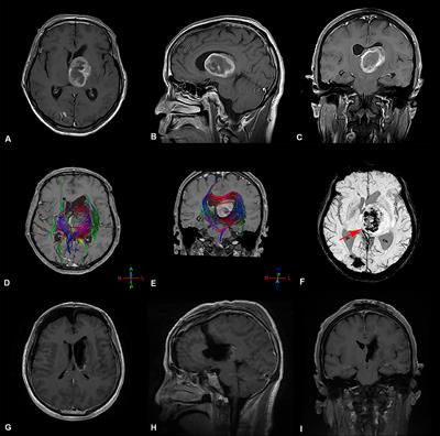 Frontiers | Risk Factors for Early Hydrocephalus on Post Unilateral ...