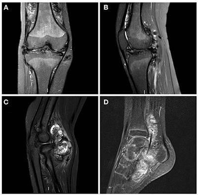 Frontiers | Imatinib, a New Adjuvant Medical Treatment for Multifocal ...