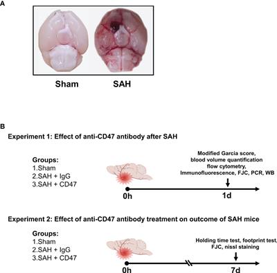 Subarachnoid Hemorrhage (SAH) - Trial Exhibits Inc.