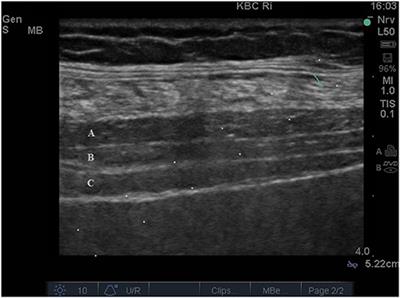 Frontiers  Ultrasound-guided transversus abdominis plane block as