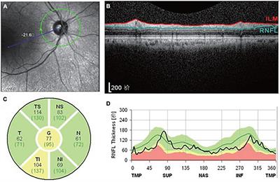 Study links drinking coffee and tea to increased macular retinal nerve  fiber layer thickness